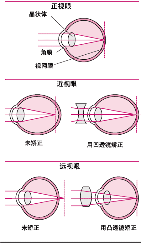 眼的屈光