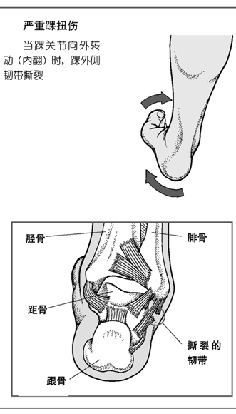 踝扭伤