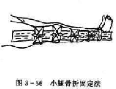 小腿骨折固定法