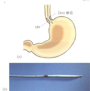 Dent袖套感受器，及进行LES测压时感受器的位置