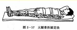 大腿骨折固定法