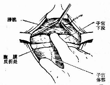 游离膀胱