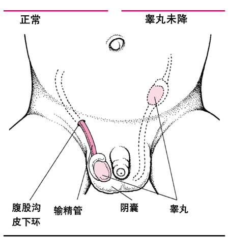 隐睾症