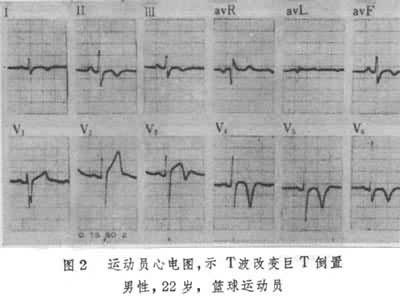 运动员心脏心电图