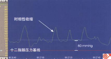 Oddi括约肌运动功能紊乱患者