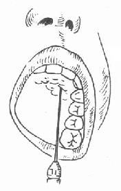 切牙孔注射