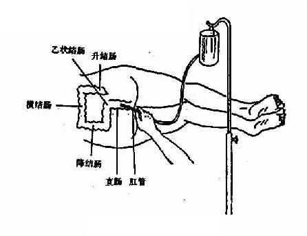 灌肠法