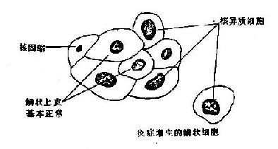 高分化鳞癌与鳞状化生， 核异质细胞鉴别示意图