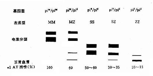 常见α1AT变异型电泳图谱及其活性