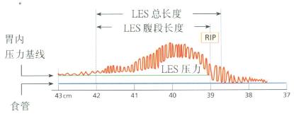 LES总长度及腹段长度可由LES牵拉测压结果计算出来